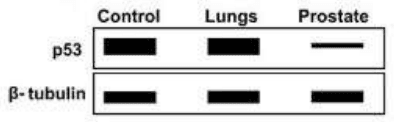 Immunoblot of p53 and beta-tubulin in control, lung and prostate